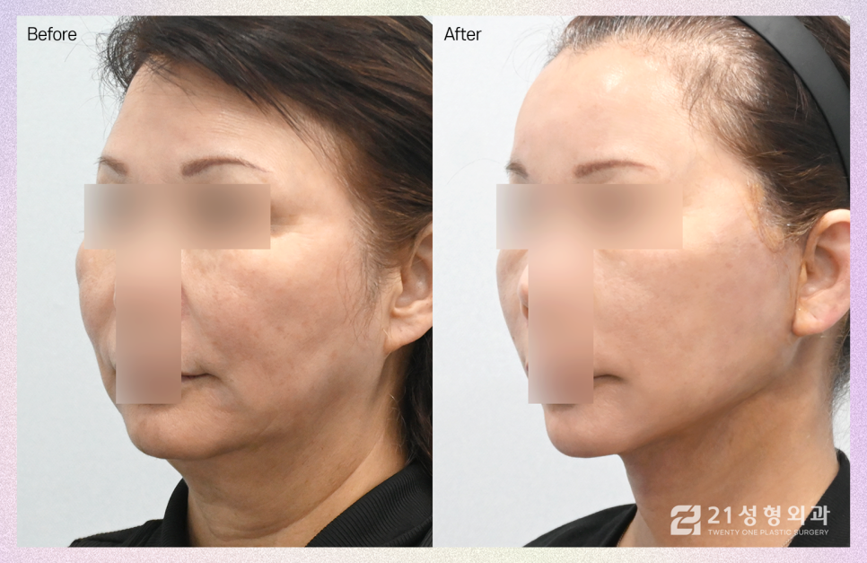 안면거상술잘하는곳 결정할 때 중요한 부분 관련 이미지 2