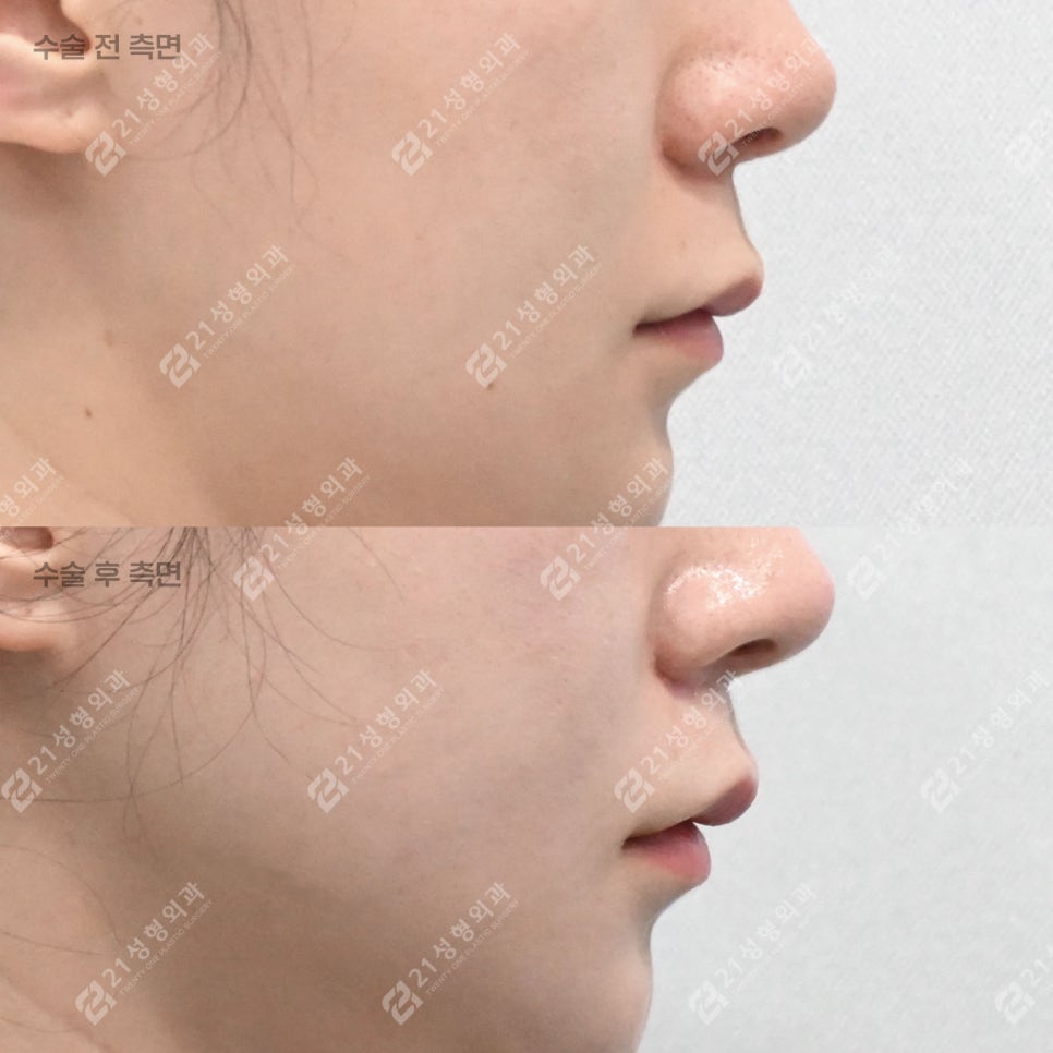 Lip Lift Review | What Matters More Than Length Is Facial Proportion! image 9