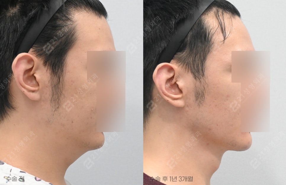 Have You Regretted Having Only Double-Chin Liposuction? Why Muscle Tightening May Be Needed for Successful Double-Chin Surgery image 1