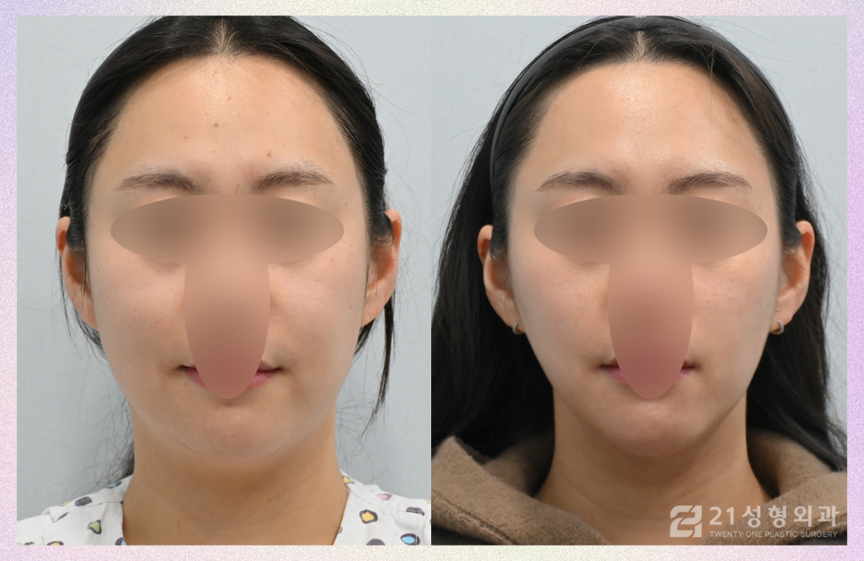 이중턱지방제거 콤플렉스라면 관련 이미지 1