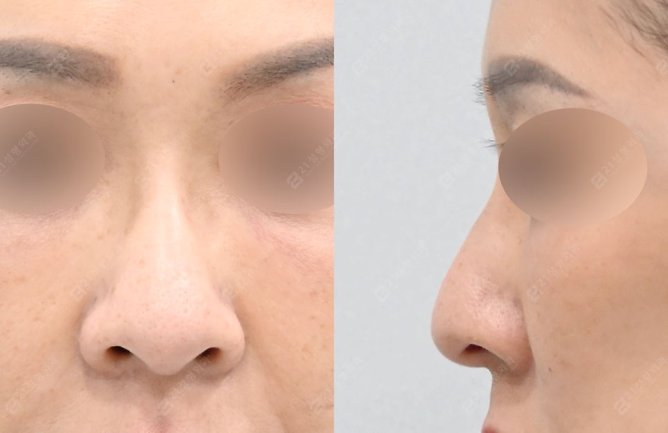 A Real Nose Surgery Review That Combines Safety and Naturalness image 2