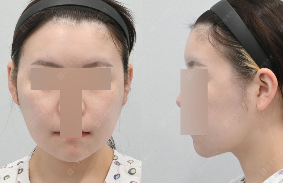 Can I Have a Clean Jawline Too? A Real Review of Double Chin Removal image 5