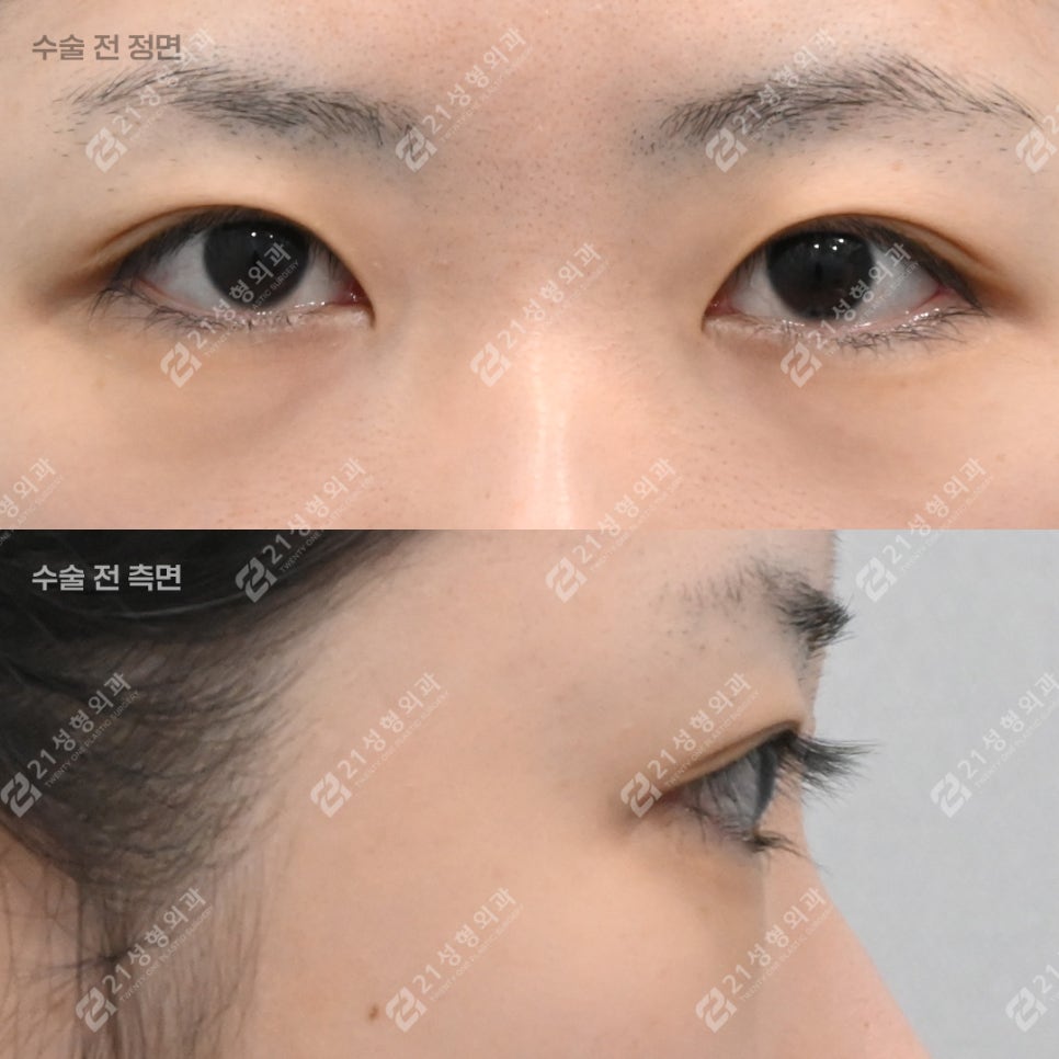 Will Under-Eye Fat Repositioning Improve the Appearance of a Tired-Looking Face? image 3