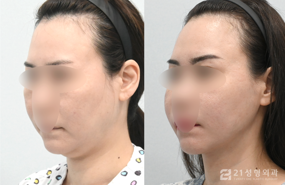 턱밑침샘개선방법으로 이중턱 얼굴라인을 갸름하게 관련 이미지 2