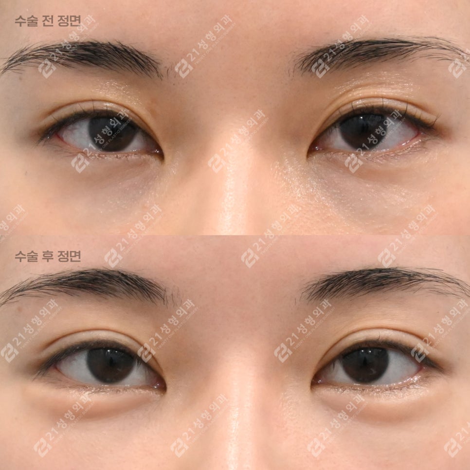 Key Points That Change Your Impression: Under-Eye Fat Repositioning and Nano-Pet Fat Grafting image 2
