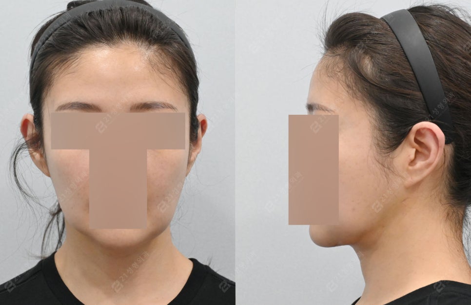 Real Review: A Smooth Improvement of Leftover Double Chin and Jowl Fat Even After Dieting image 4