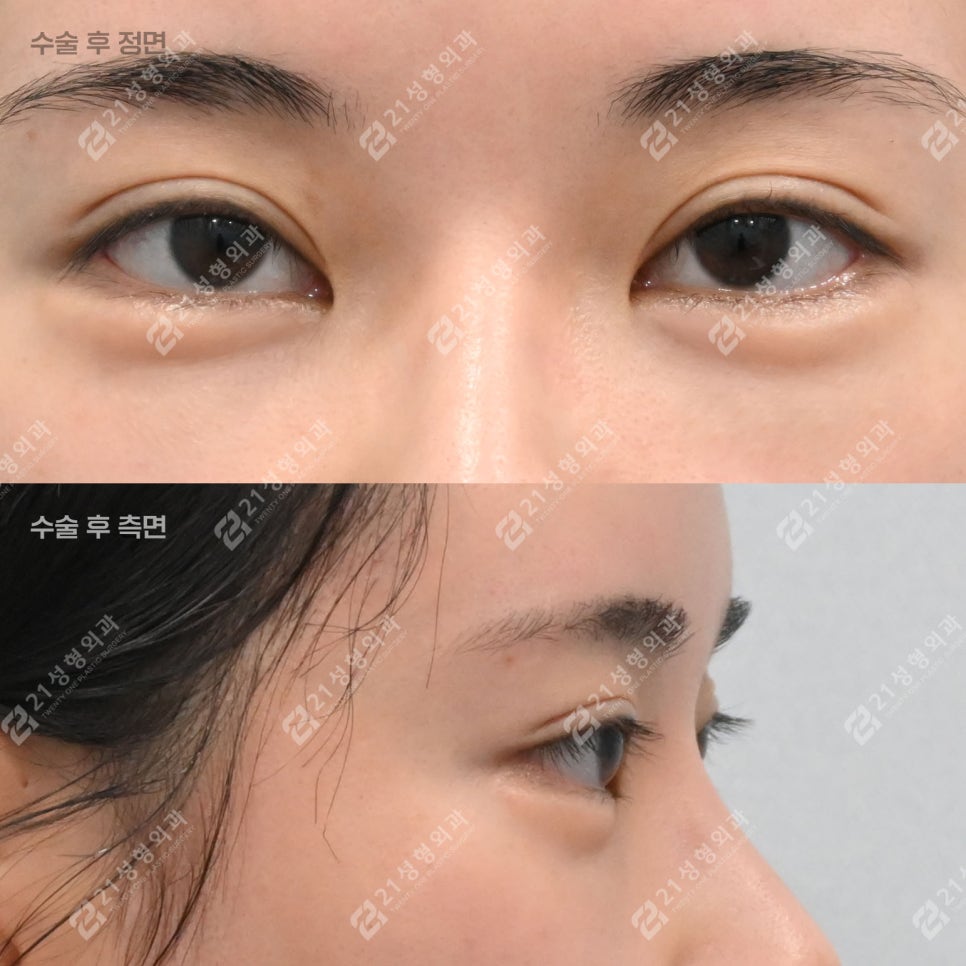 Key Points That Change Your Impression: Under-Eye Fat Repositioning and Nano-Pet Fat Grafting image 4