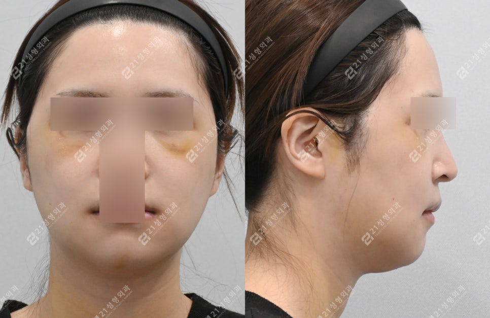 안면비대칭 개선된 윤곽수술전후 케이스 관련 이미지 4