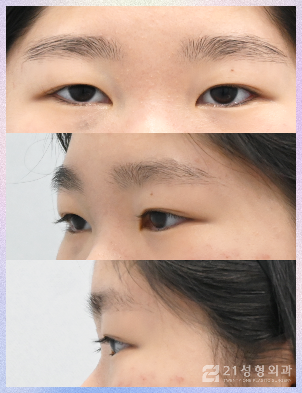 강남눈성형잘하는곳 차이점은 관련 이미지 6