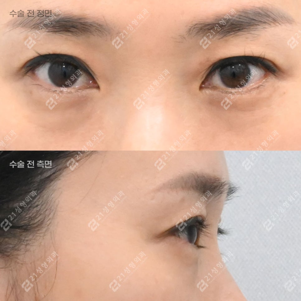 피곤해 보이던 40대 눈밑, 하안검 후 이렇게 달라졌습니다 관련 이미지 2