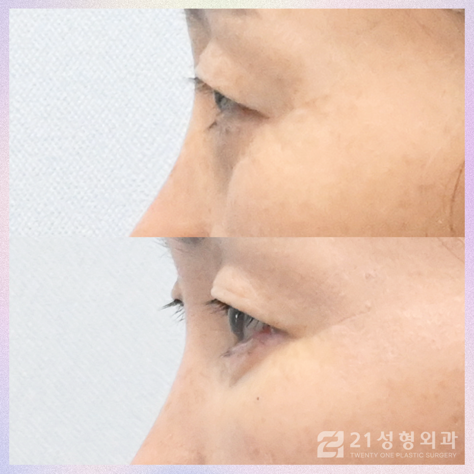 하안검수술후케어 젊음을 유지하기 위해서는 관련 이미지 3