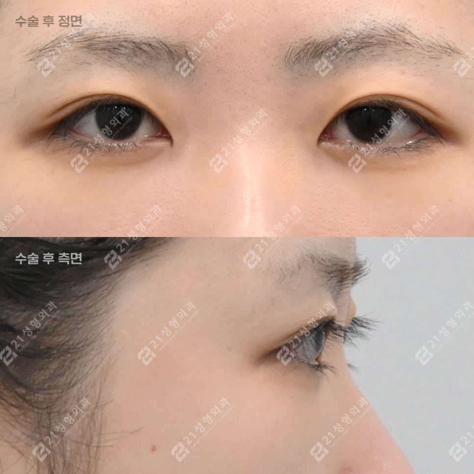 Will Under-Eye Fat Repositioning Improve the Appearance of a Tired-Looking Face? image 5