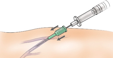 반코마이신(Vancomycin) vs 테이코플라닌(Teicoplanin) 관련 이미지 8