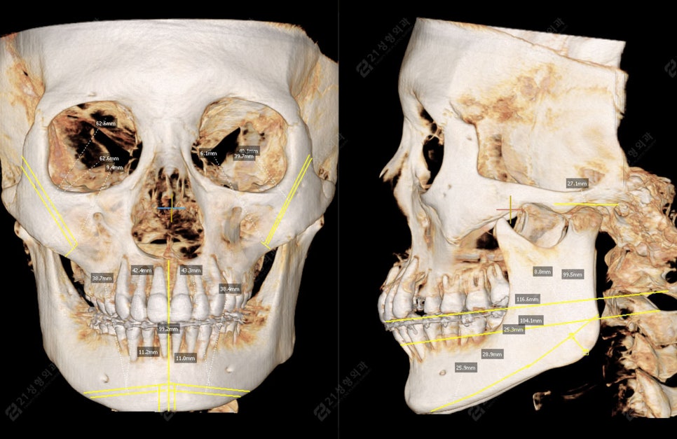 Facial Contouring, Key Points You Must Know: A Real Review of Changes Over 1 Year and 6 Months image 3