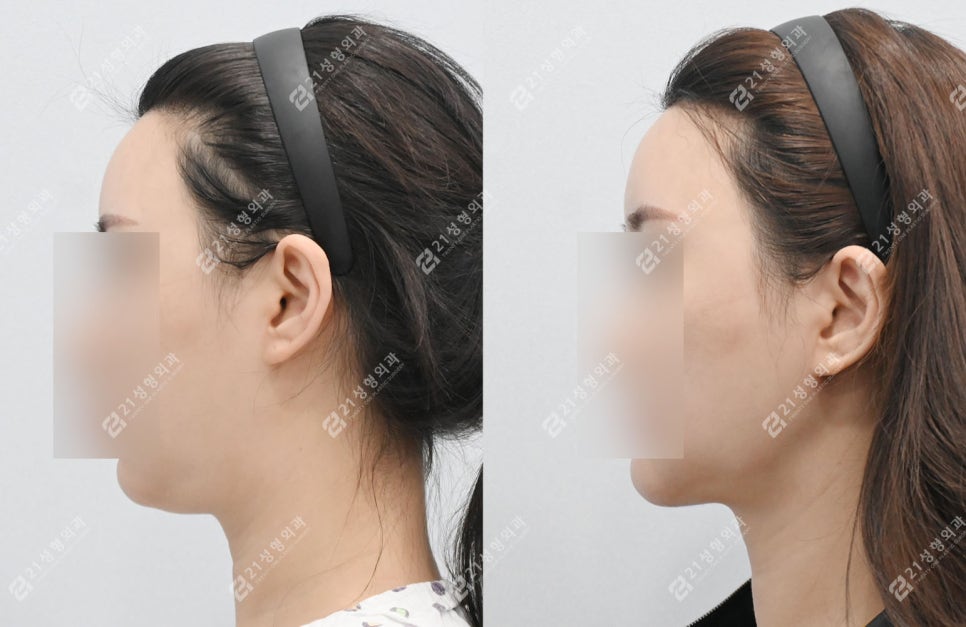 이중턱 수술 후 딱딱함&middot;울퉁불퉁 피부, 괜찮은걸까? 관련 이미지 8