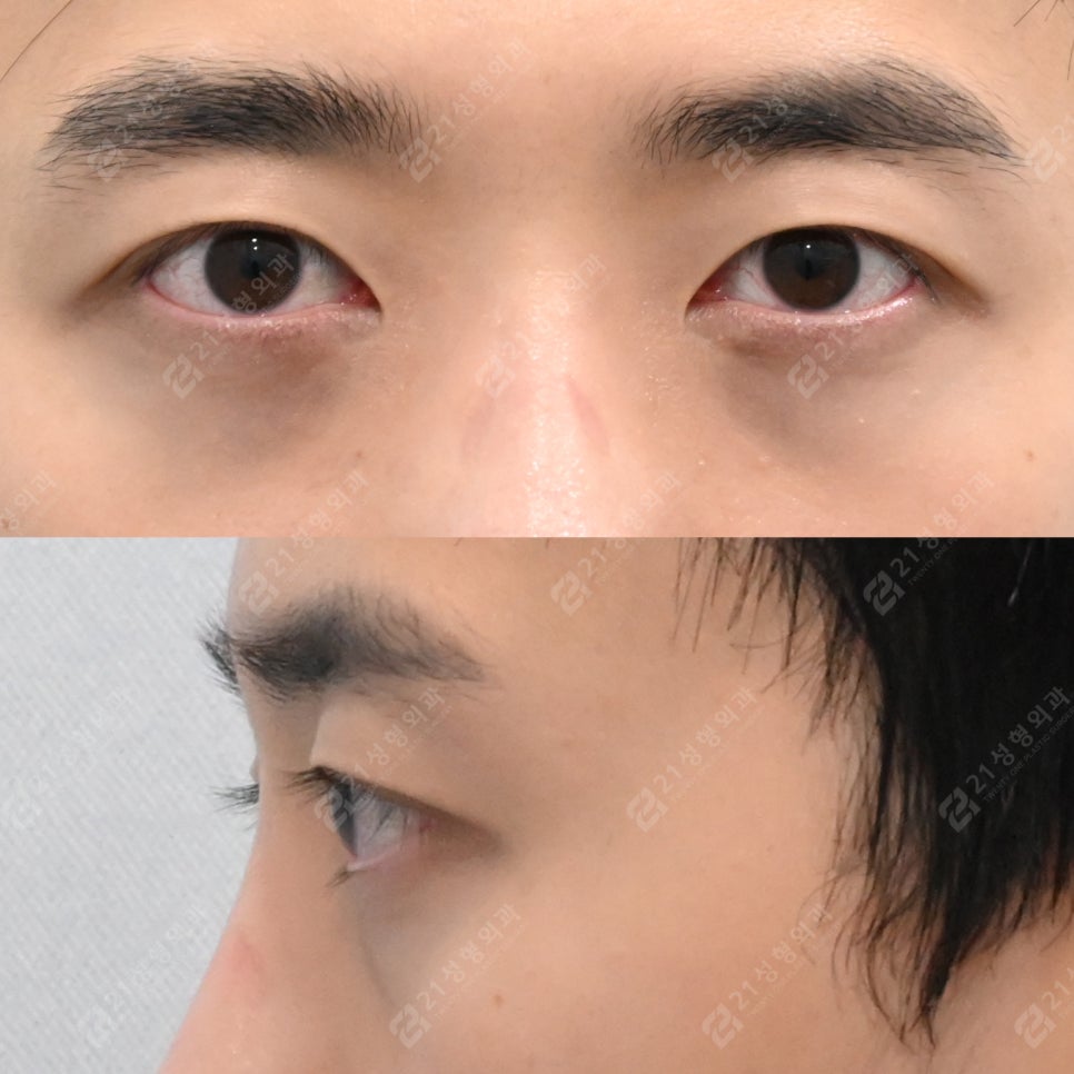 Before-and-After Case of Lower Eyelid Fat Repositioning Surgery for Men image 2