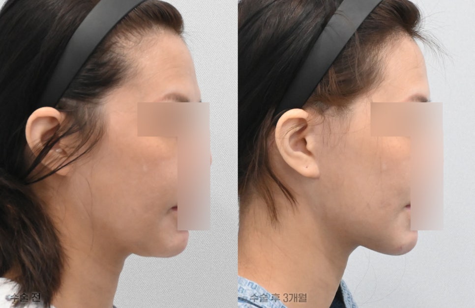Pixie Ears After a Facelift: Why Do They Differ from Clinic to Clinic? Find Out at 21 Plastic Surgery image 6