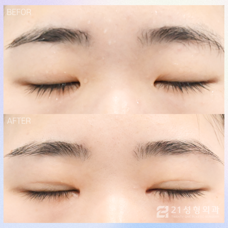 절개쌍꺼풀을 통한 자연스러운 라인 관련 이미지 2
