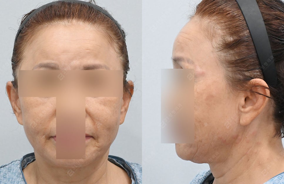 Let’s Address Facial Sagging from the Root Cause! Real Changes from a Face and Neck Lift image 2