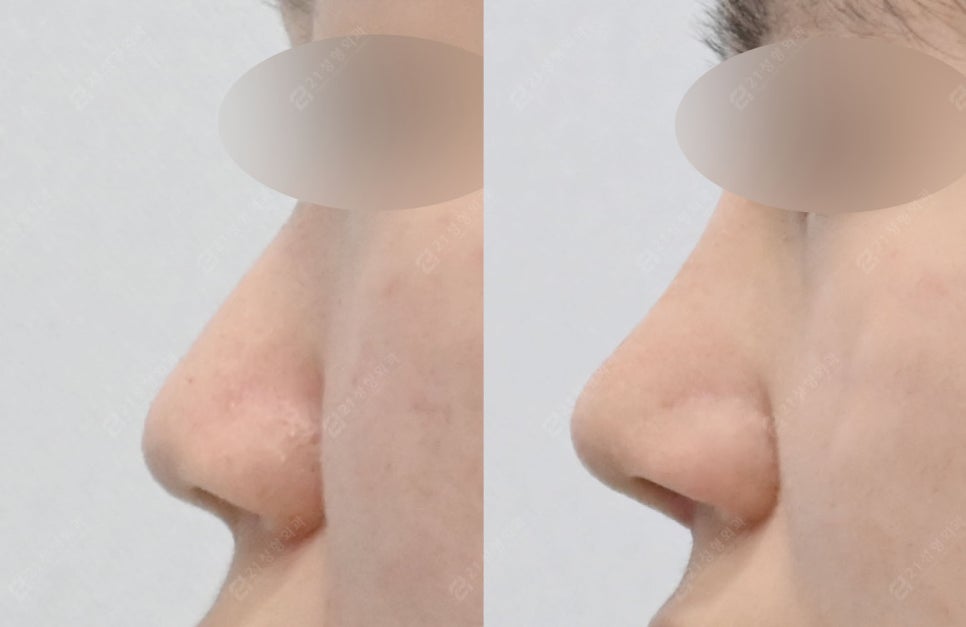 코성형 재료 완벽 분석, 내게 맞는 코성형 고르는 법! 관련 이미지 8