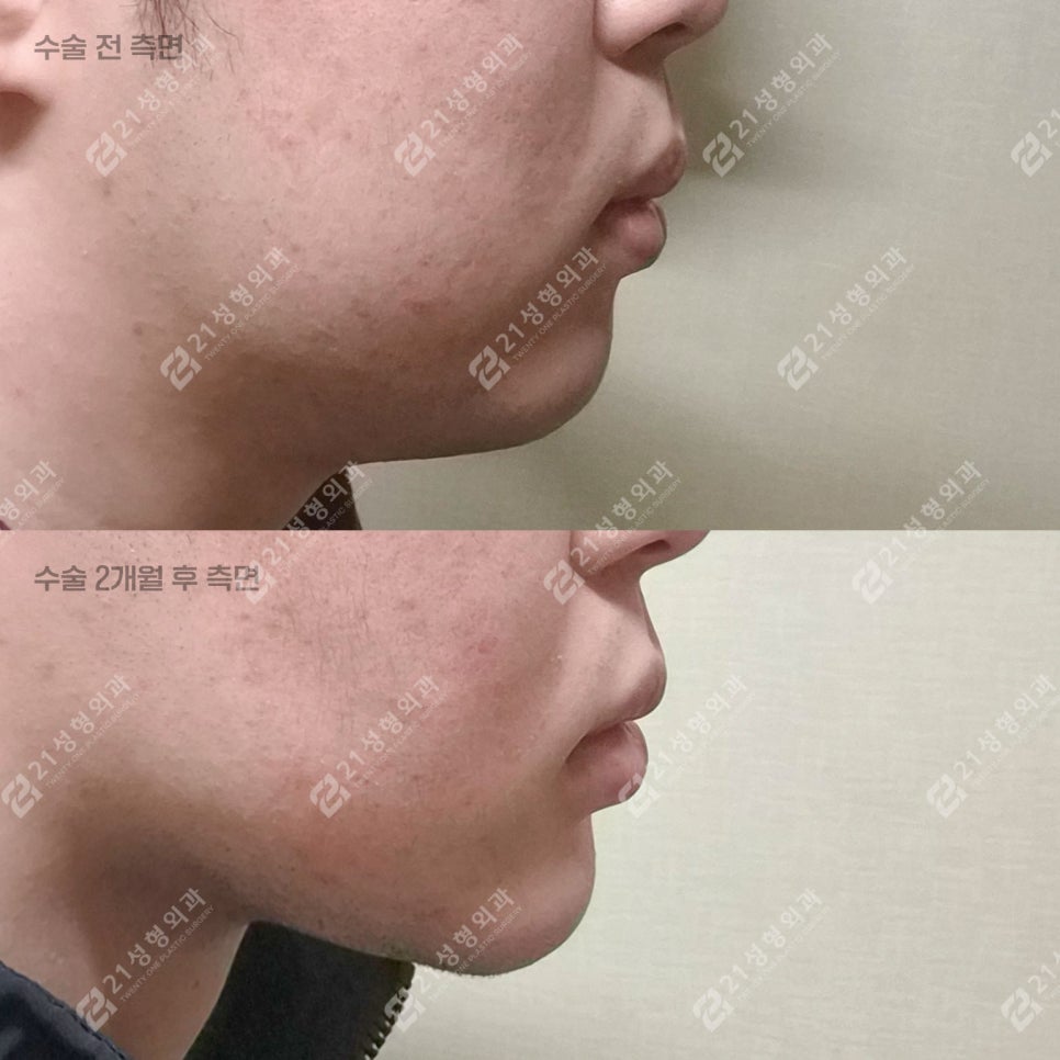 Male Double Chin + Chin Advancement Surgery Real Case: Why the Mood and Impression Change image 2