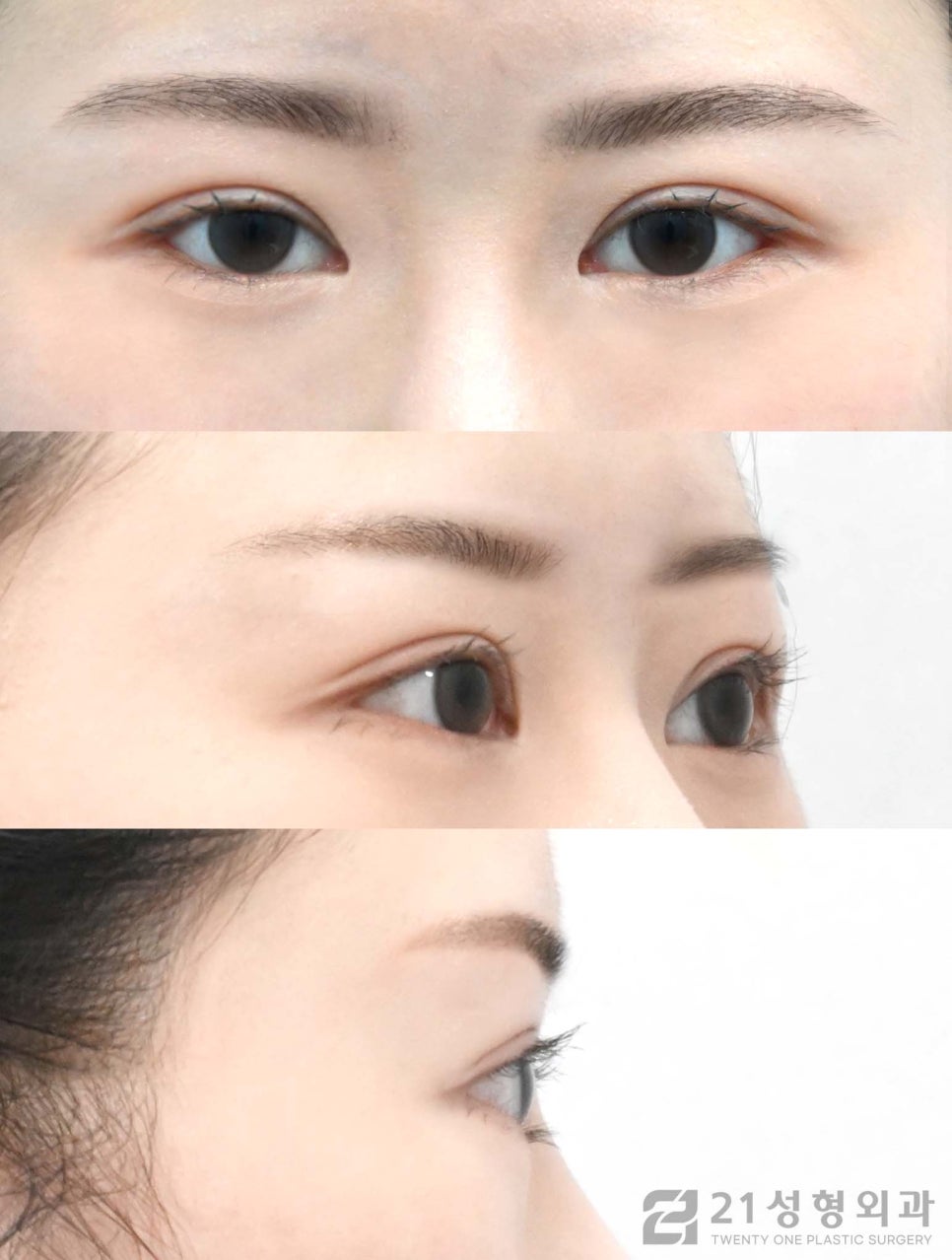 절개쌍수 특징적인 점에 대하여 관련 이미지 4