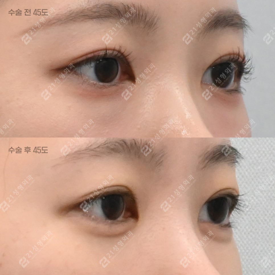 다크서클도, 애교살도 21성형외과에서 한 번에 해결! 관련 이미지 2