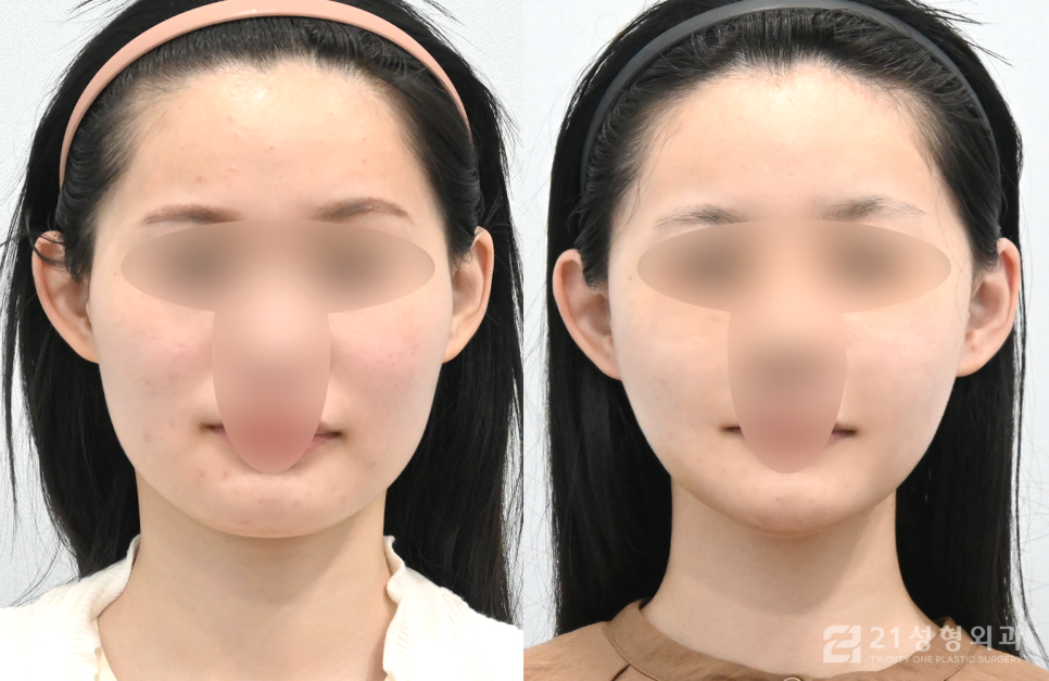 안면윤곽잘하는병원 선택할 때 중요한 점 관련 이미지 1