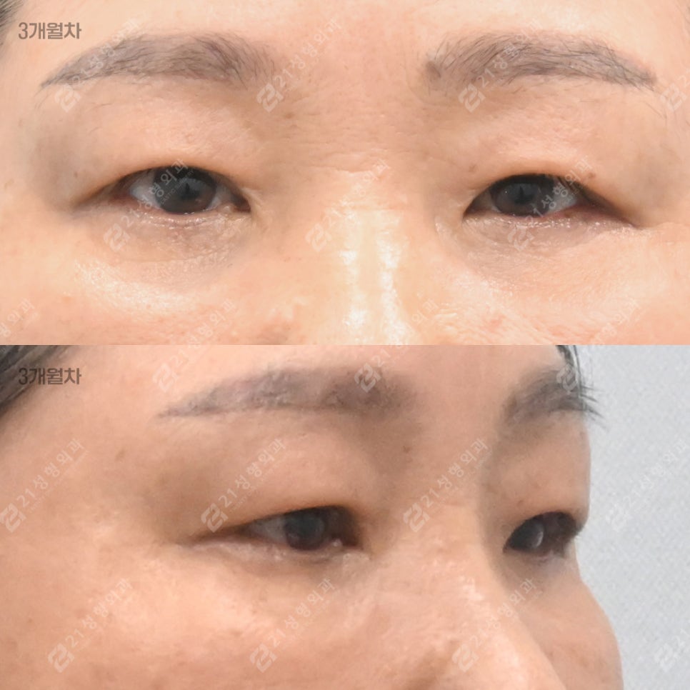 Do Your Eyes Feel Heavy and Constricted? 21 Plastic Surgery Explains How to Self-Assess for a Sub-Brow Lift image 6