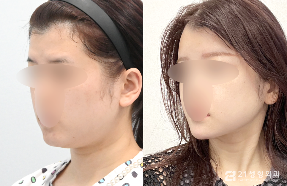 안면윤곽3종 달라지는 라인의 비결 관련 이미지 2