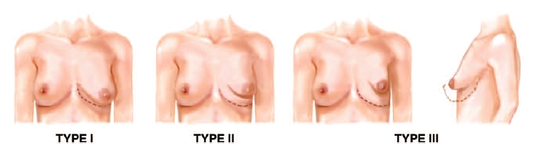관상형 유방 (Tubular breast) 관련 이미지 3