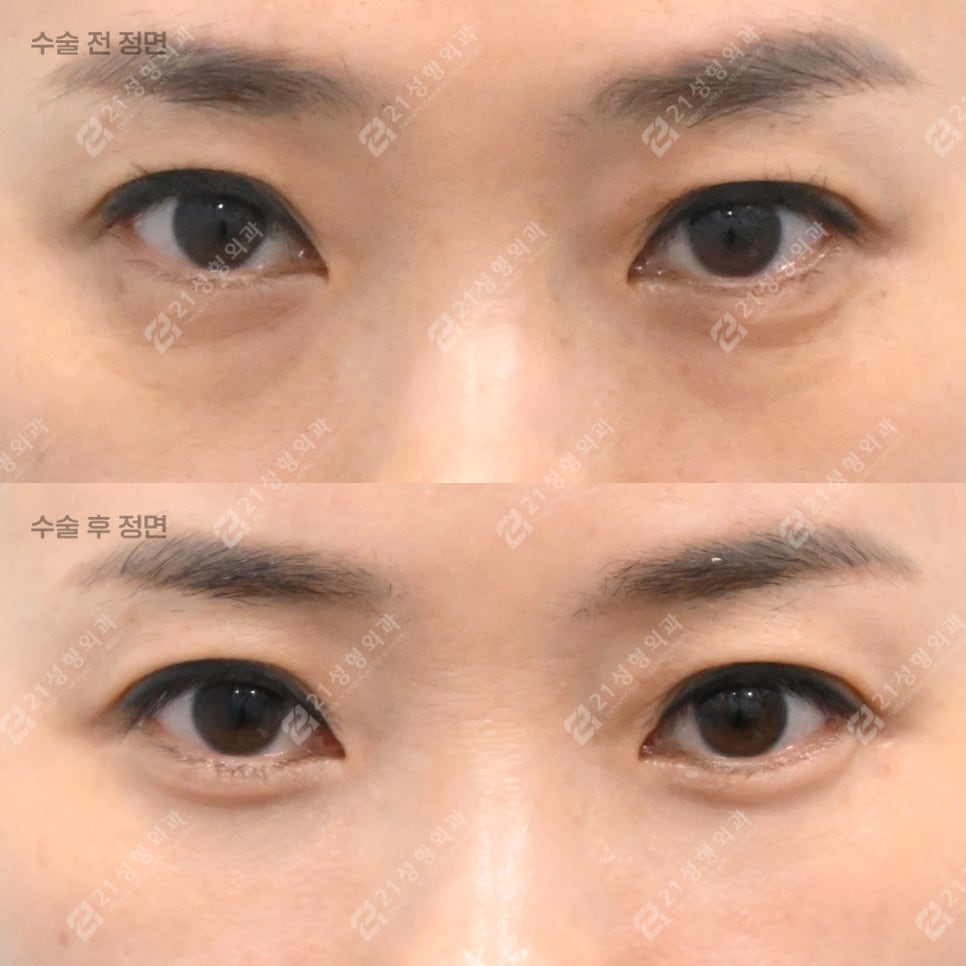 상담할 때 눈밑 피부를 먼저 확인하는 이유 관련 이미지 1