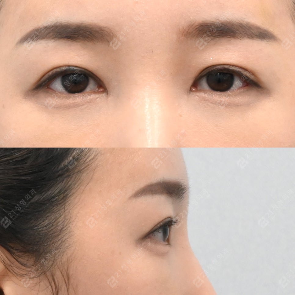 눈밑지방재배치 후 부기 오래가는 이유 관련 이미지 5