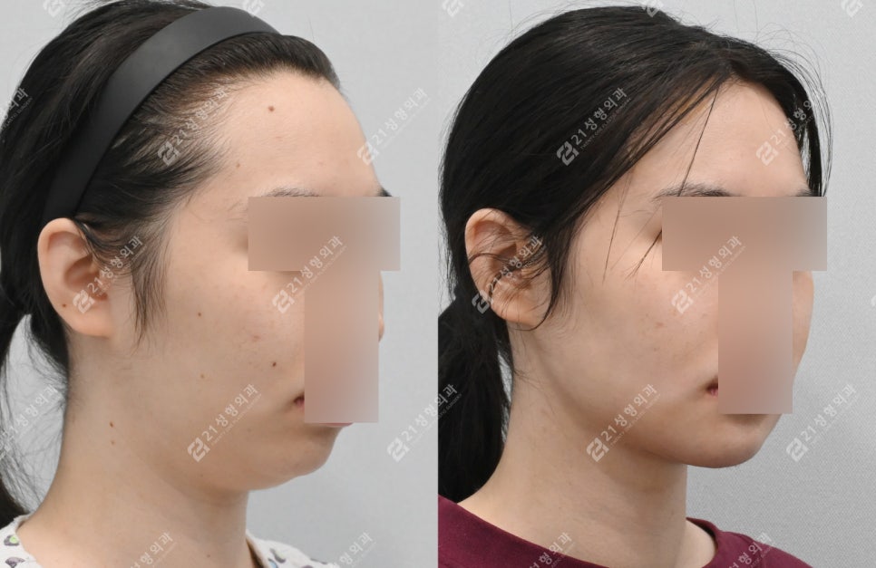 턱끝성형 : 턱끝전진술+이중턱근육묶기 실제 환자 리뷰 관련 이미지 4