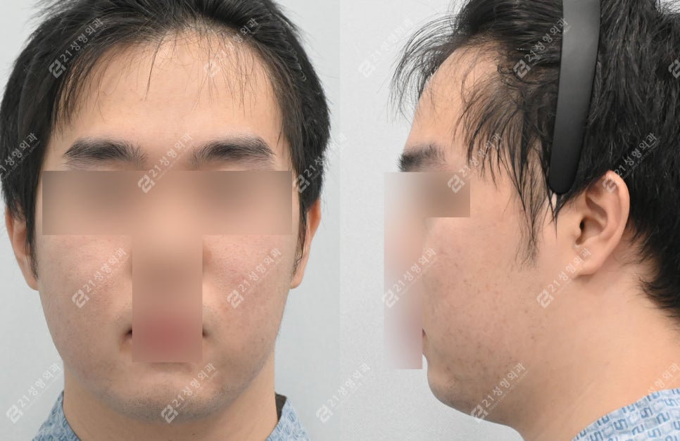 Male Double Chin + Chin Advancement Surgery Real Case: Why the Mood and Impression Change image 3