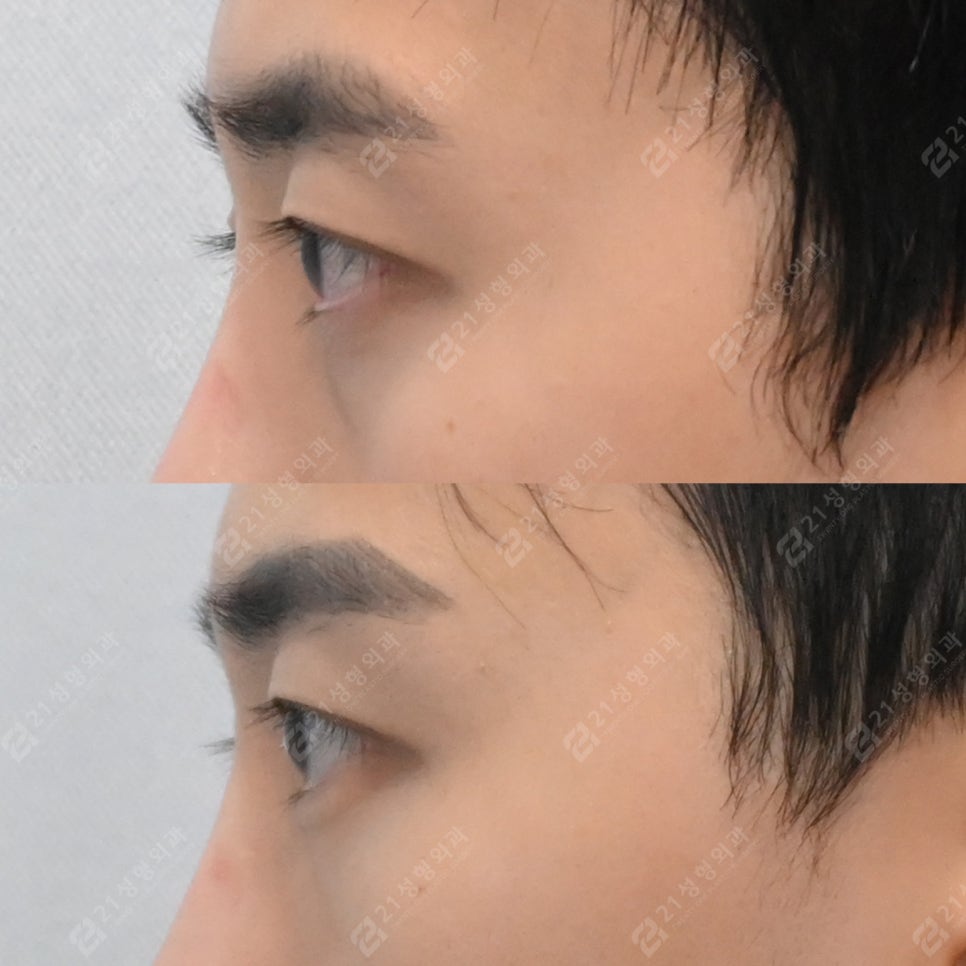 Before-and-After Case of Lower Eyelid Fat Repositioning Surgery for Men image 4