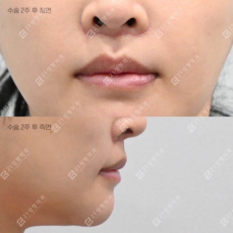 A Lip-Philtrum Reduction Surgery Case: Why Philtrum Dimple Surgery Was Performed Together image 5