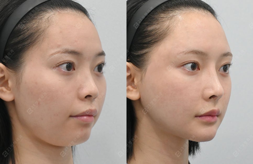 Facial Contouring, Key Points You Must Know: A Real Review of Changes Over 1 Year and 6 Months image 9
