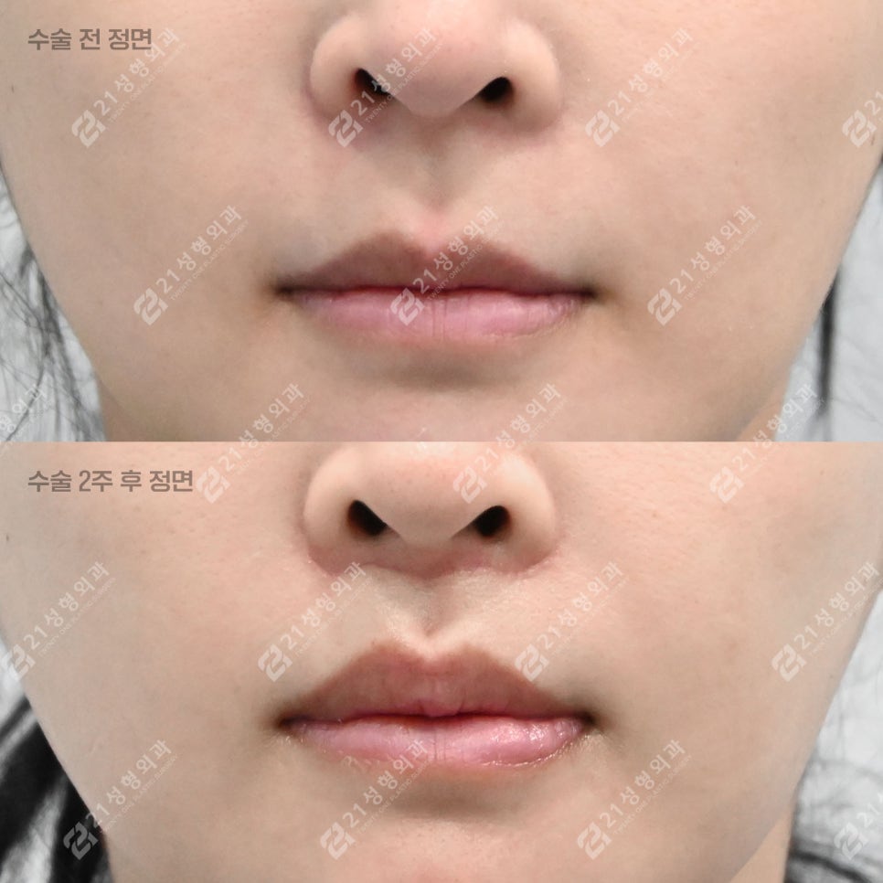 A Lip-Philtrum Reduction Surgery Case: Why Philtrum Dimple Surgery Was Performed Together image 1