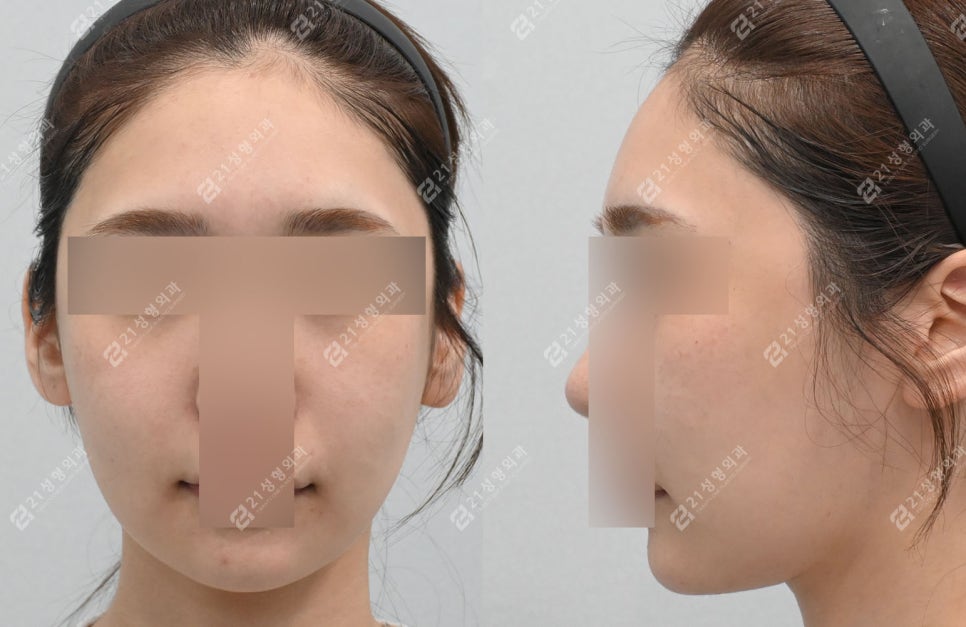 Before and After Cheekbone Reduction: Changes in Facial Width (4 Months · 1 Year) image 5