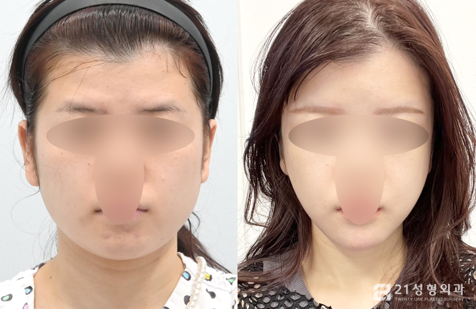 안면윤곽3종 달라지는 라인의 비결 관련 이미지 1