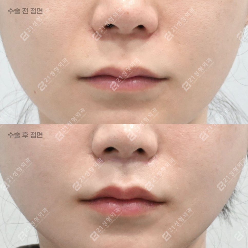 Lip Lift Review | What Matters More Than Length Is Facial Proportion! image 7