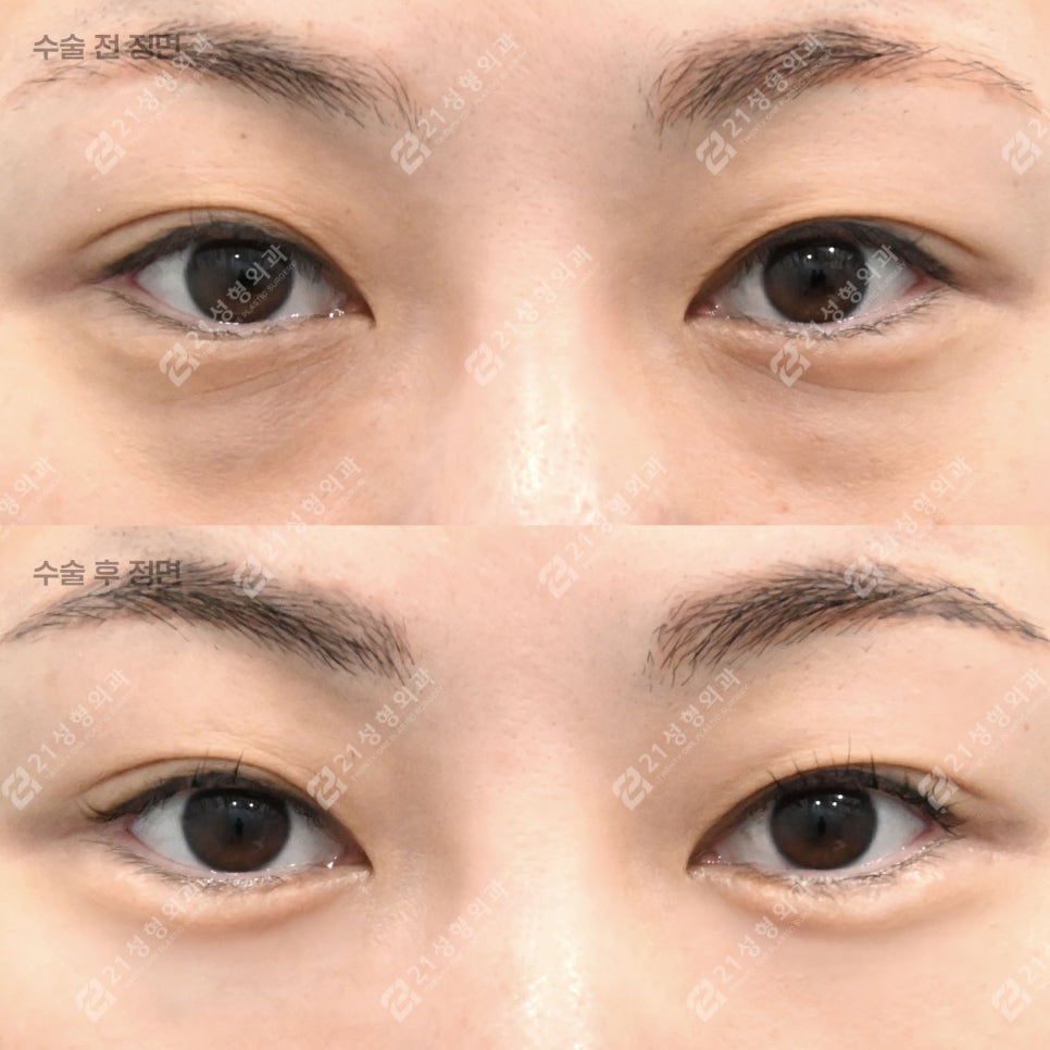 Can Tired Eyes Be Changed? A Real Review of Under-Eye Fat Repositioning for a Woman in Her Late 30s! image 1