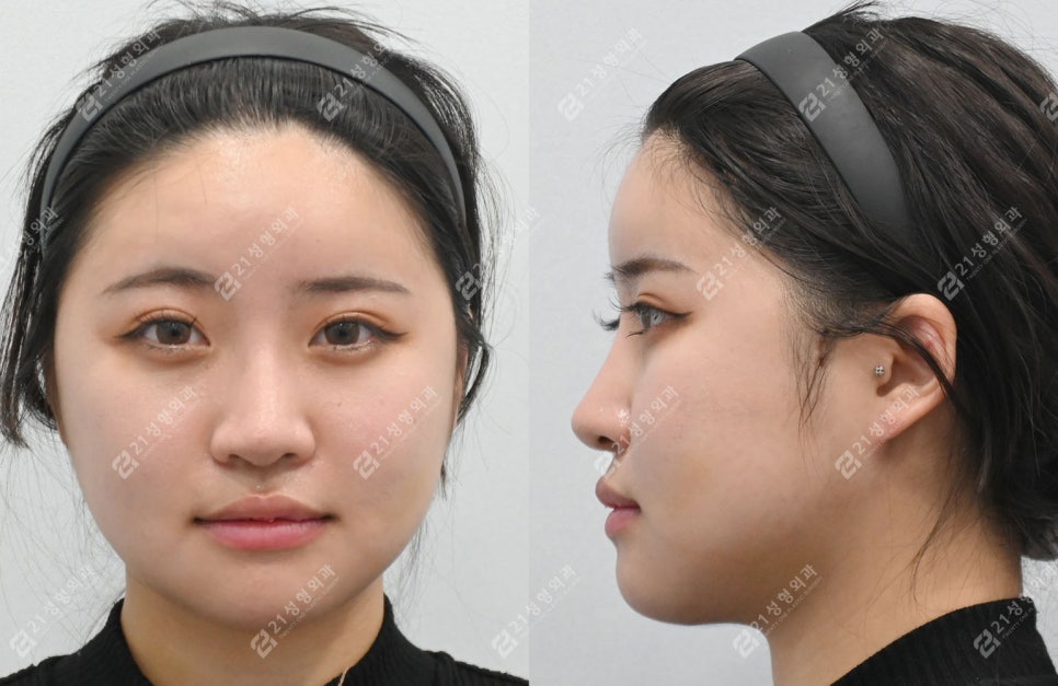 Real Review of Square Jaw Surgery: Square Jaw Surgery Is Not Over After Just Shaving the Bone image 5
