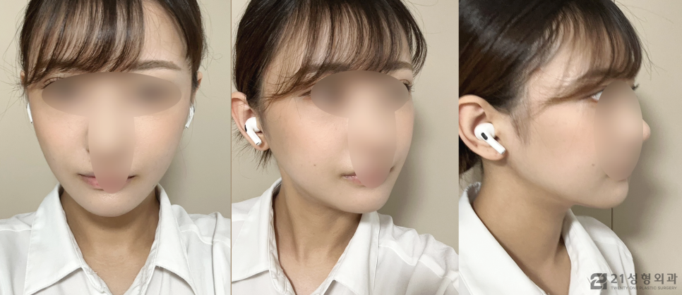 안면 윤곽 수술 잘하는 곳 신중하게 찾아보자 관련 이미지 4