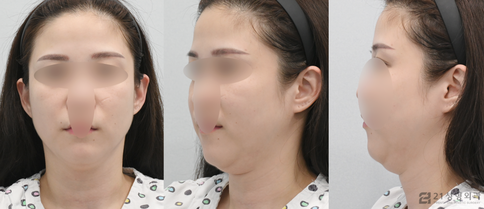 강남이중턱지방흡입, 빠른 효과를 기대한다면 관련 이미지 4