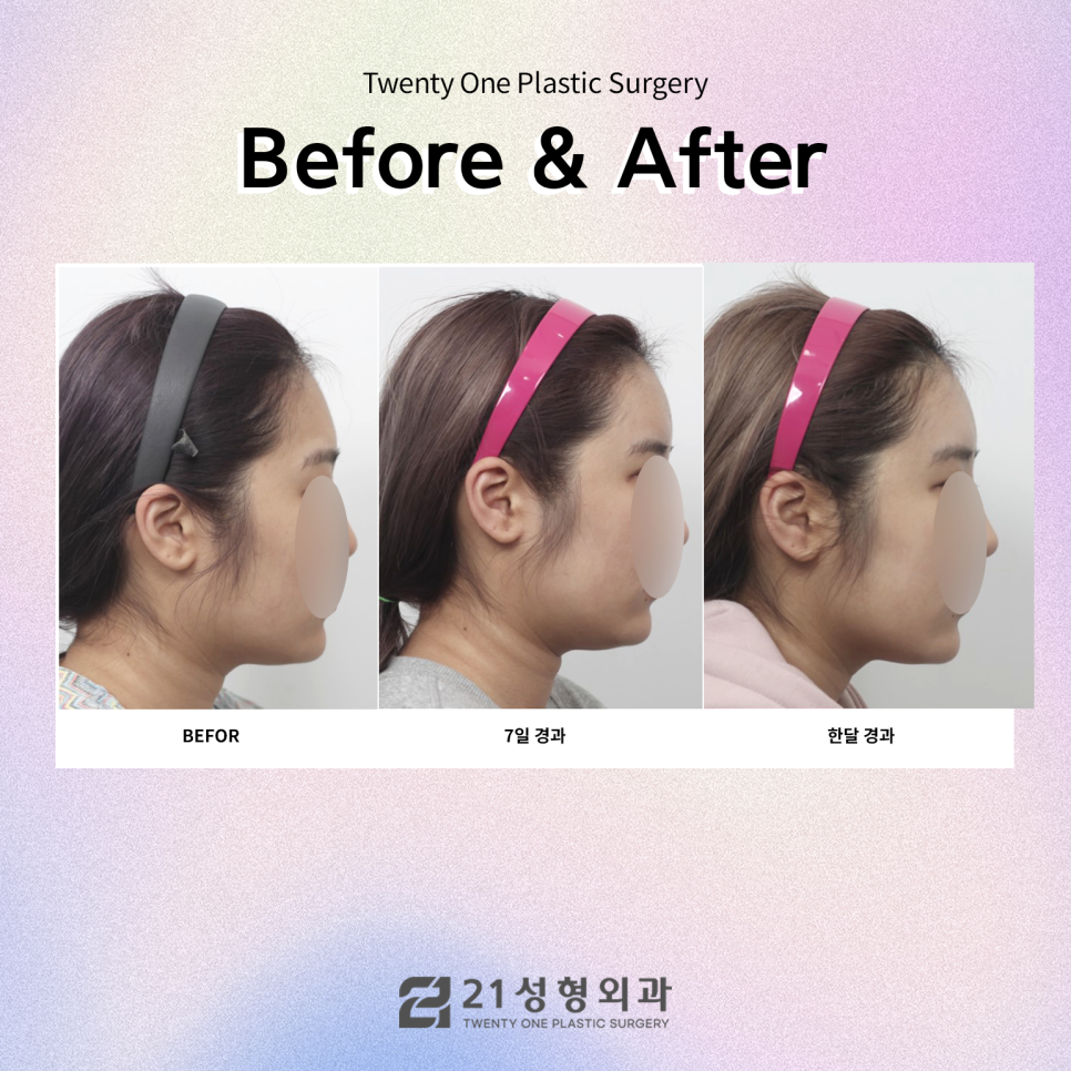 자가지방유지기간 효과를 높이려면면 관련 이미지 7