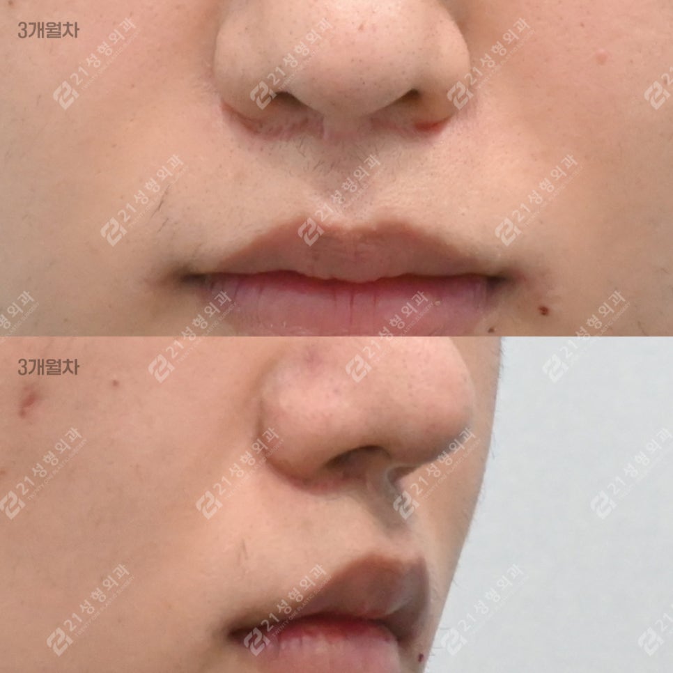 I Almost Gave Up Thinking My Long Philtrum Was Genetic—Until I Finally Looked Into 21 Plastic Surgery image 6