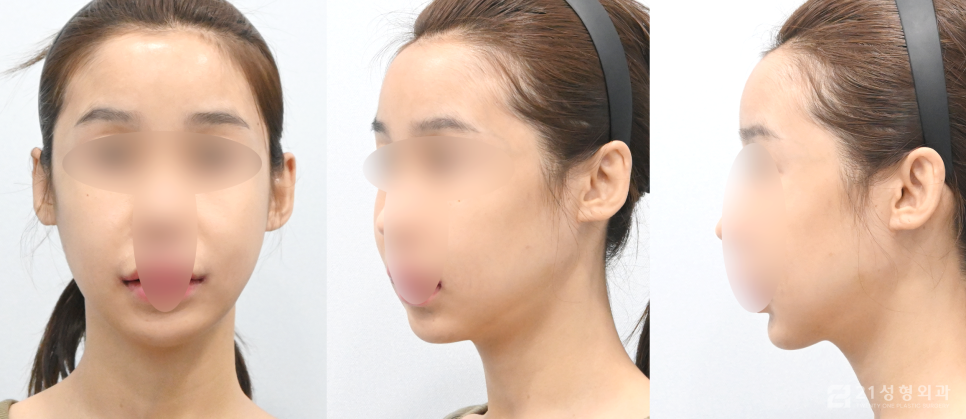 사각턱수술잘하는곳 정보를 알고 싶다면 관련 이미지 5