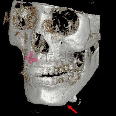 사각턱 후 비대칭이 된 수술부작용사례 : 이차각과 비대칭 관련 이미지 2